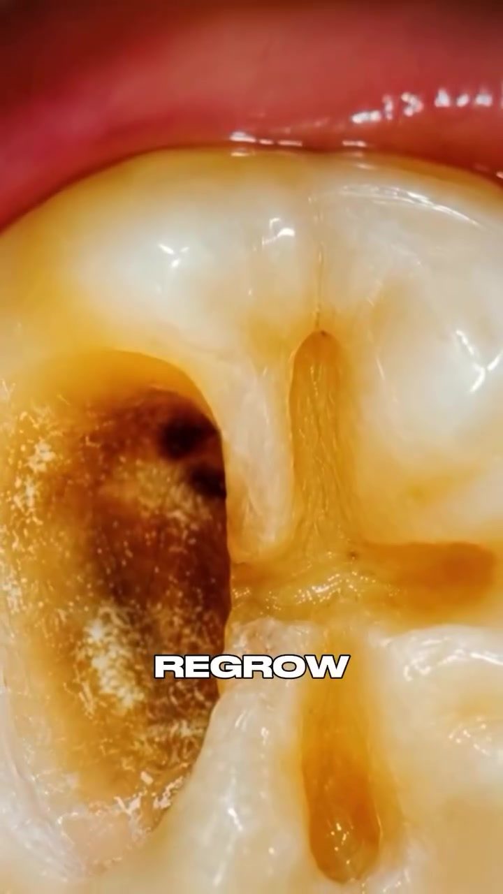Drilling-Free Enamel Regrowth: The New Dental Gel Revolution