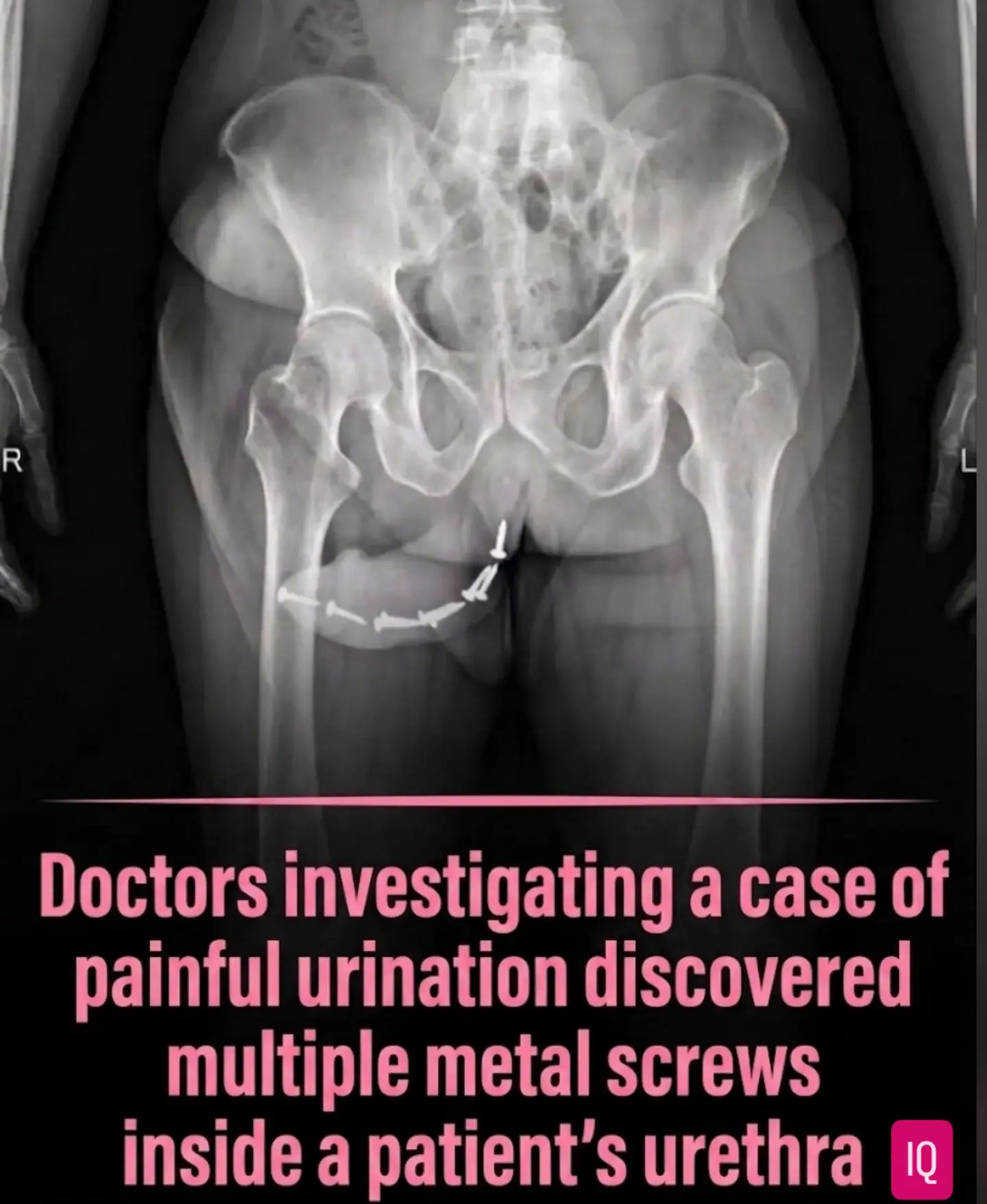 Medical Mystery: Multiple Metal Screws Found in Patient's Urethra