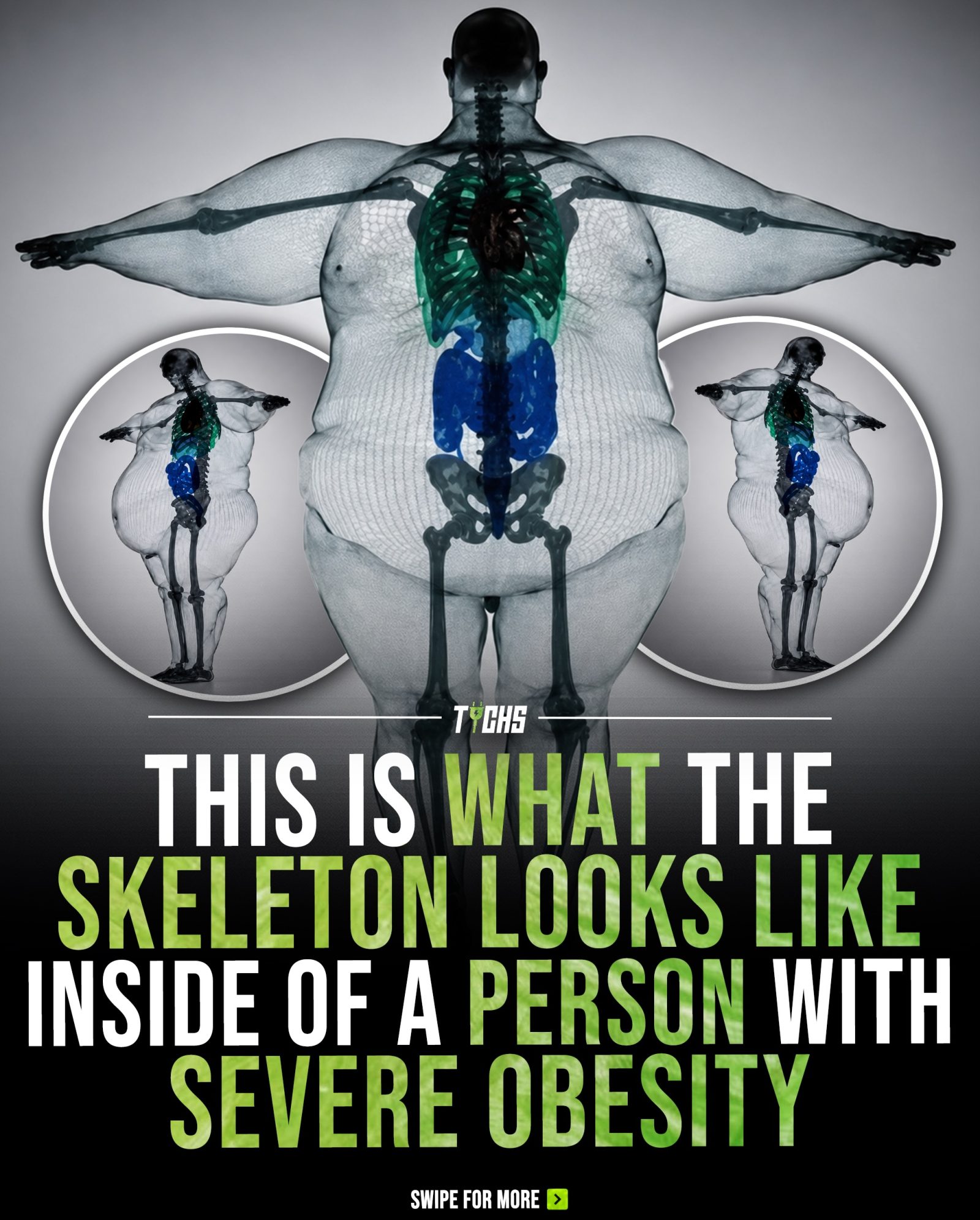 Understanding How Severe Obesity Impacts Internal Body Structure