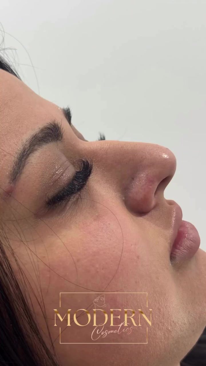 Learn About Modern Cosmetics' Personalized Lip Filler Consultations