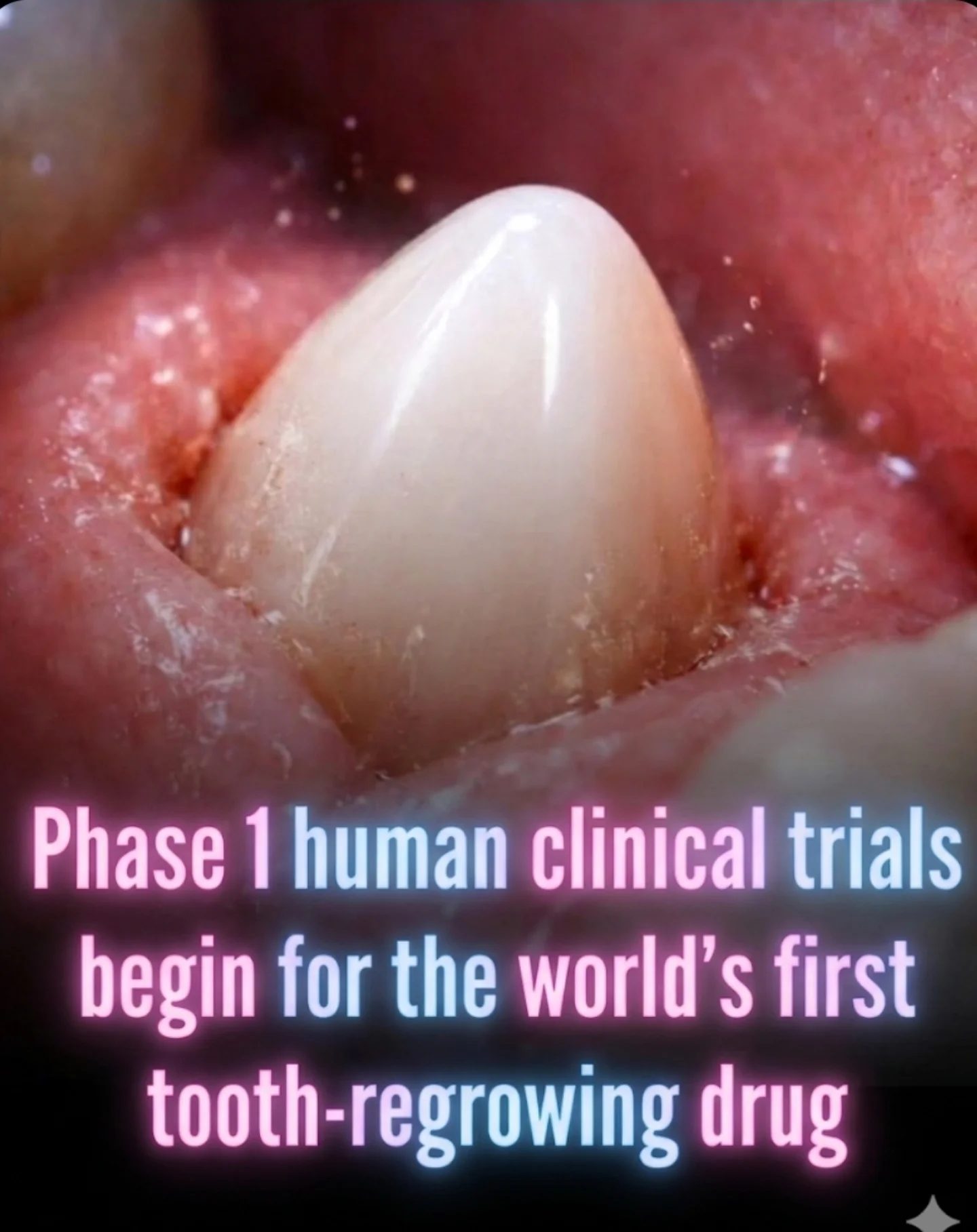 Groundbreaking Tooth Regrowth Drug in Phase 1 Clinical Trials