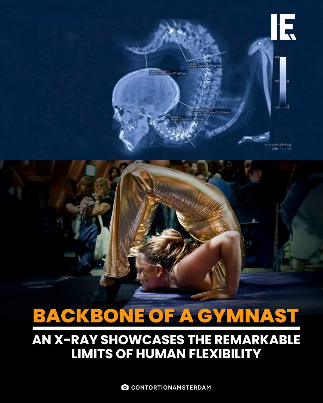 X-ray Reveals Gymnast's Incredible Spine Flexibility