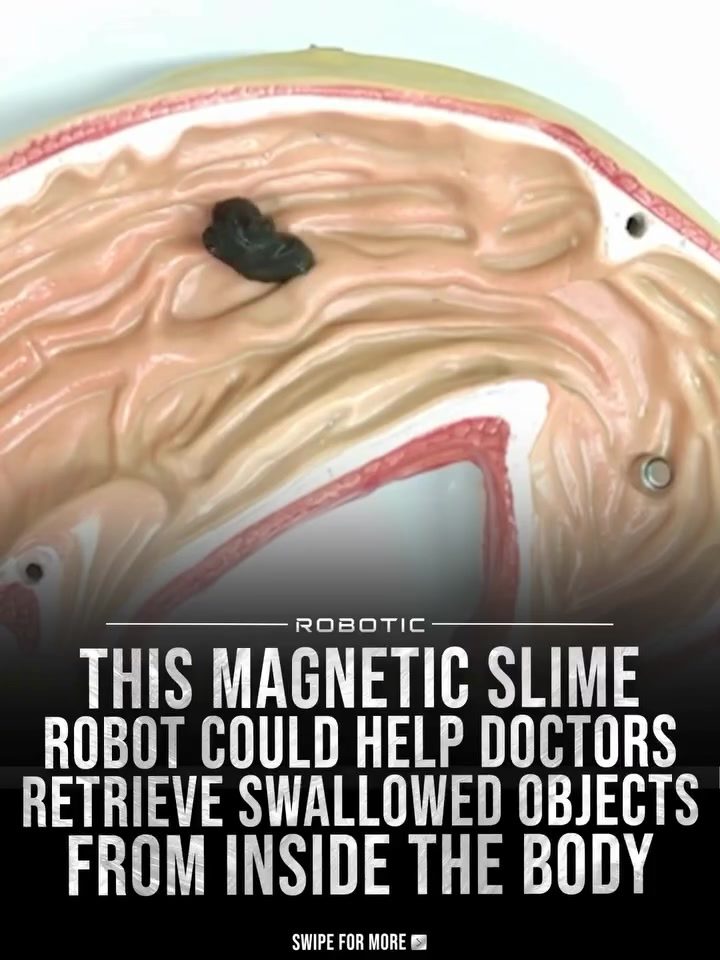 Robotic Slime: Revolutionizing Medical Retrieval of Swallowed Objects