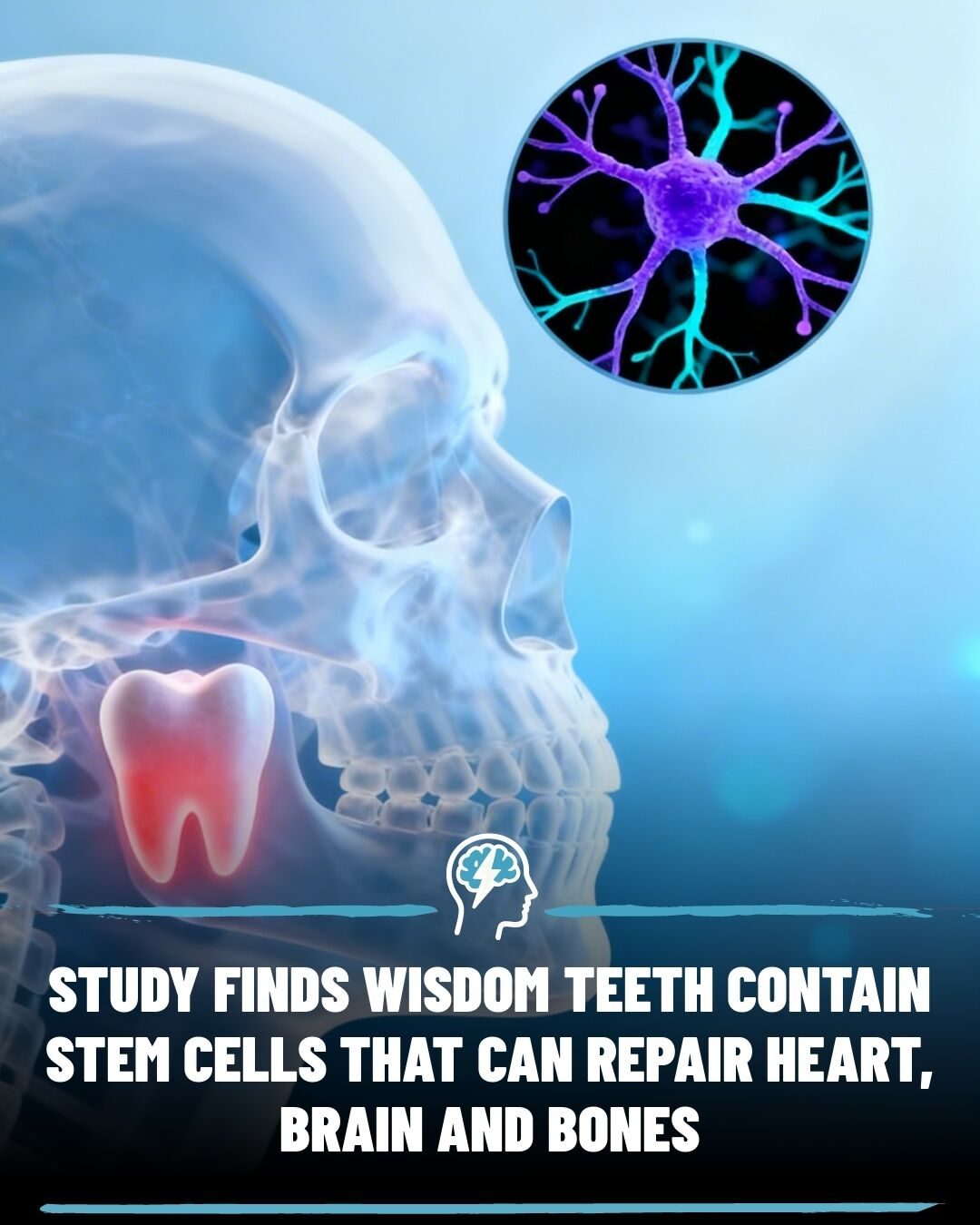 Wisdom Teeth: A Source of Powerful Stem Cells for Regenerative Medicine