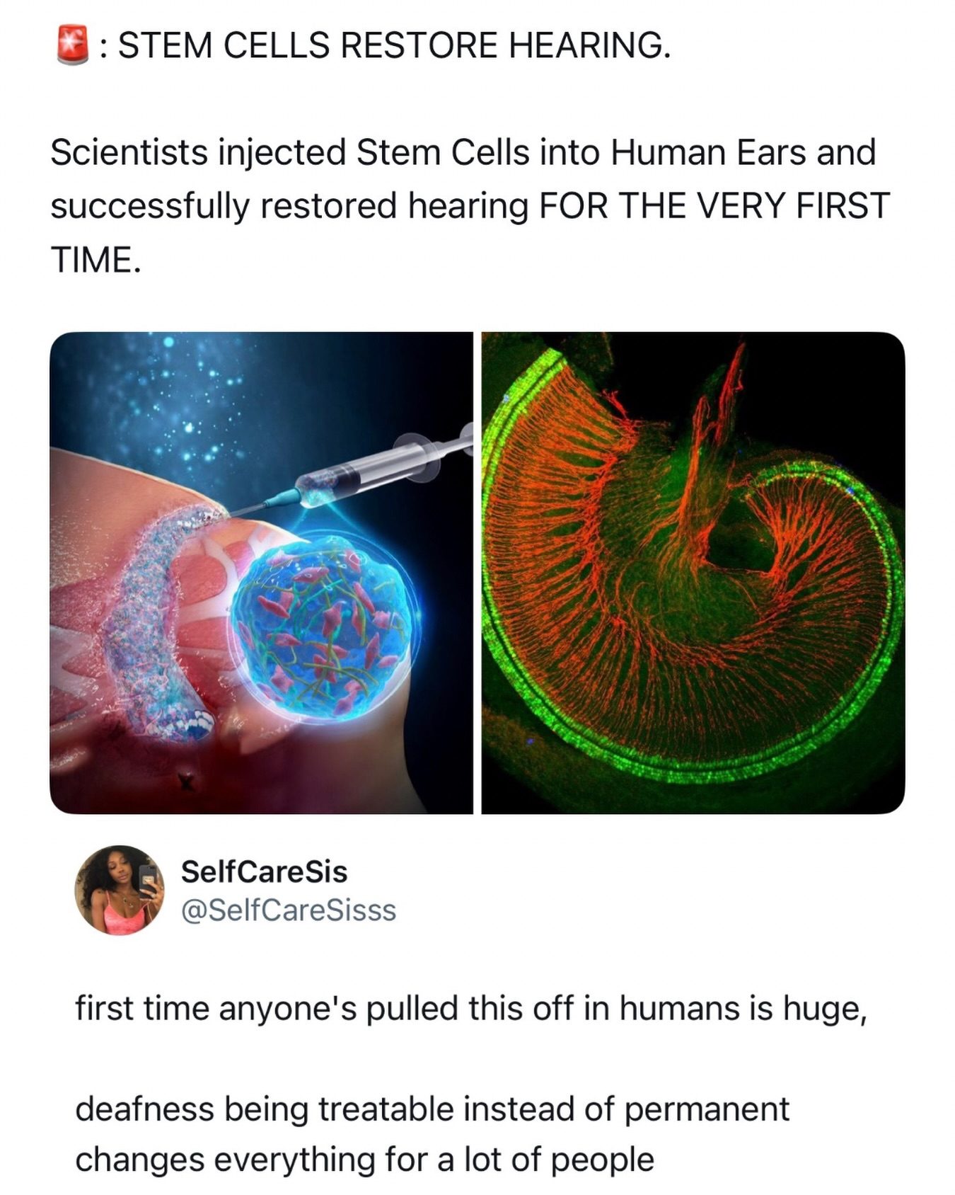 Stem Cell Breakthrough: Restoring Hearing for the First Time