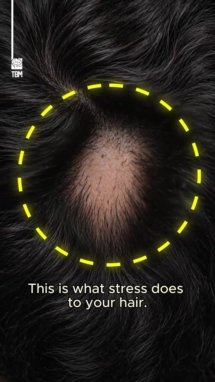 The Delayed Effects of Stress on Hair Loss