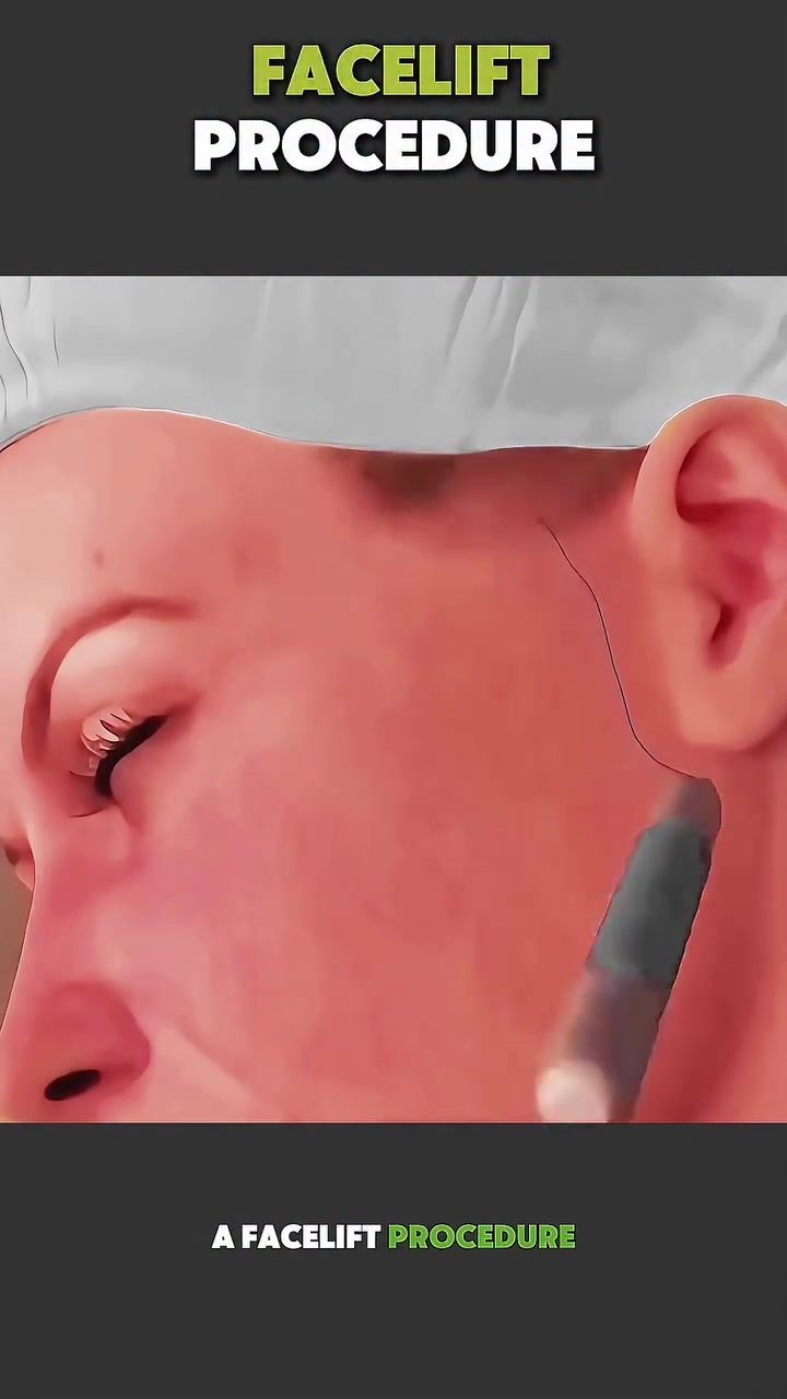 Exploring the Details of a Facelift Procedure