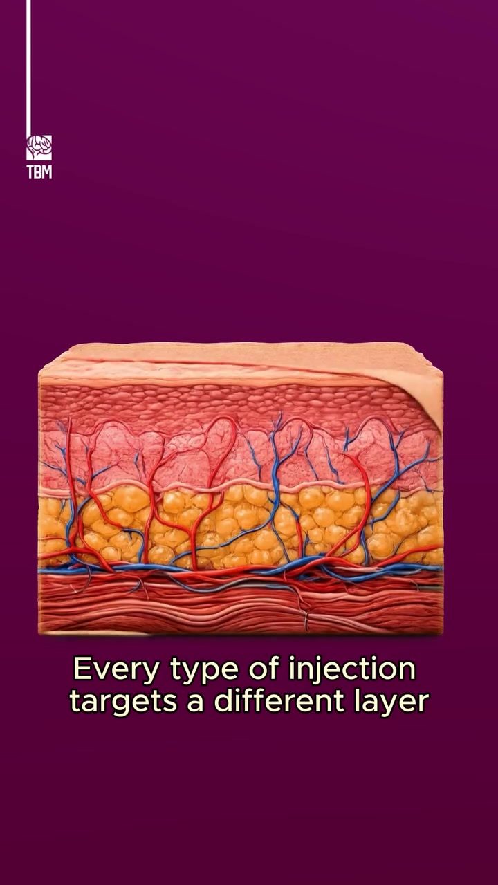 Understanding Different Injection Types