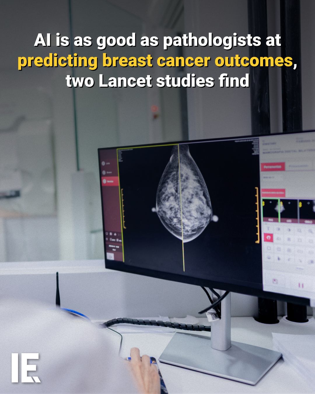 AI's Breast Cancer Prediction Accuracy vs.
