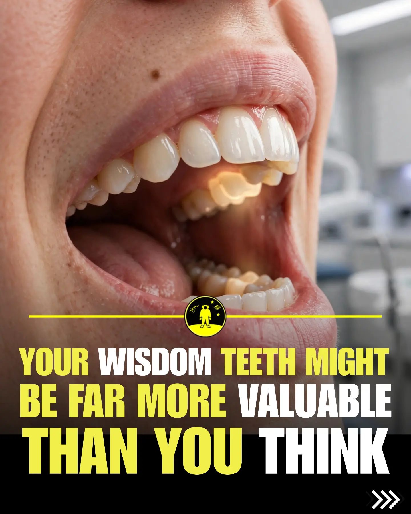 Benefits of Wisdom Teeth Stem Cells in Regenerative Medicine