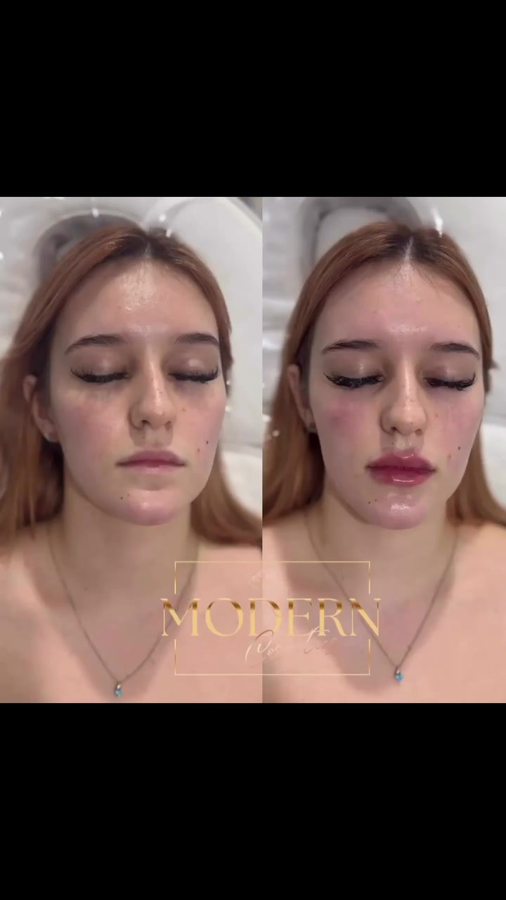 Discover Subtle Lip Enhancements at Modern Cosmetics