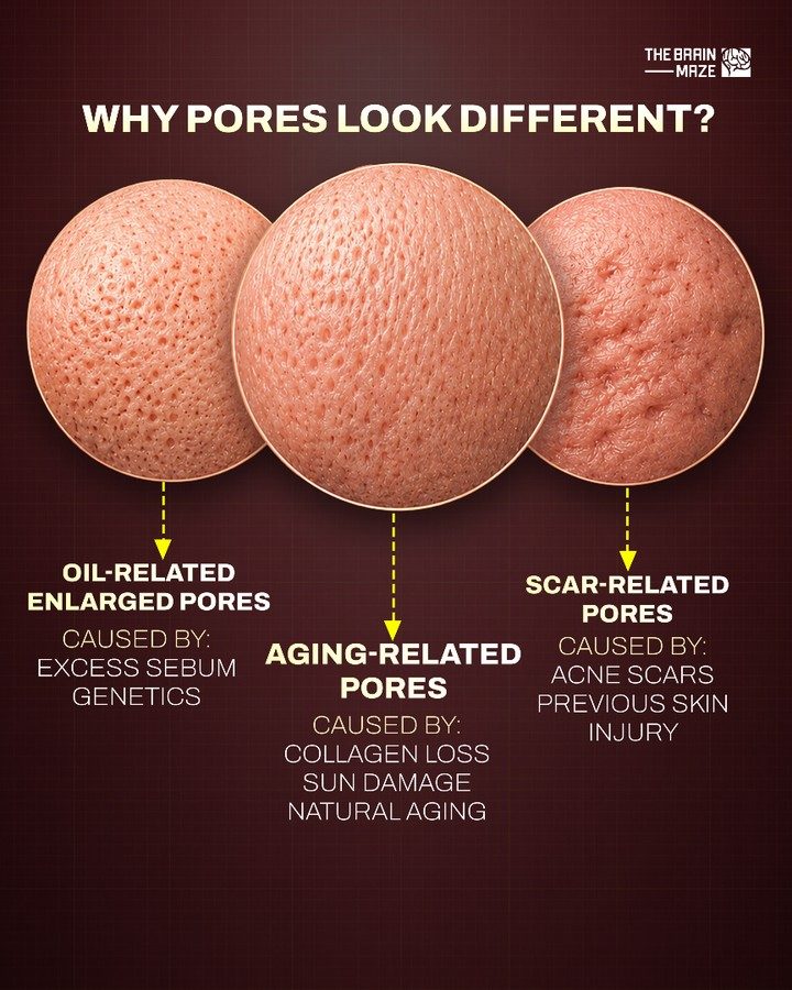 Why Pores Appear Different: Causes and Solutions