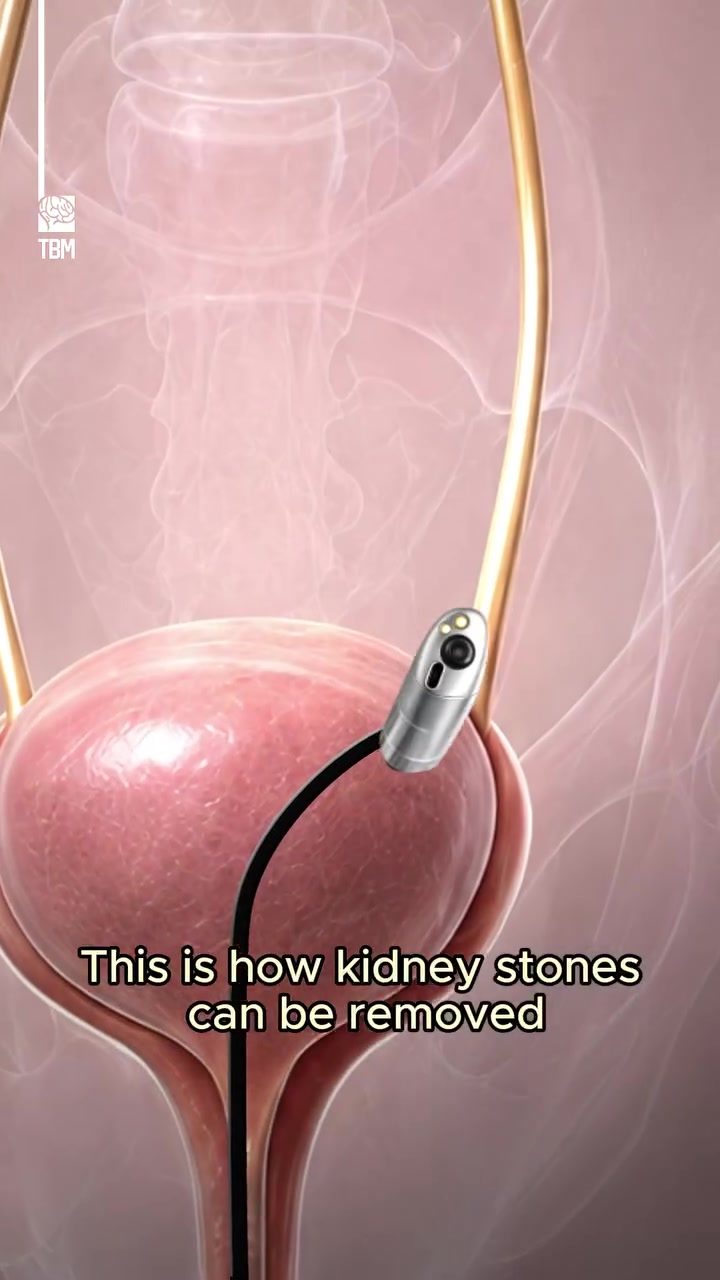 Non-Surgical Kidney Stone Removal: Understanding Ureteroscopy