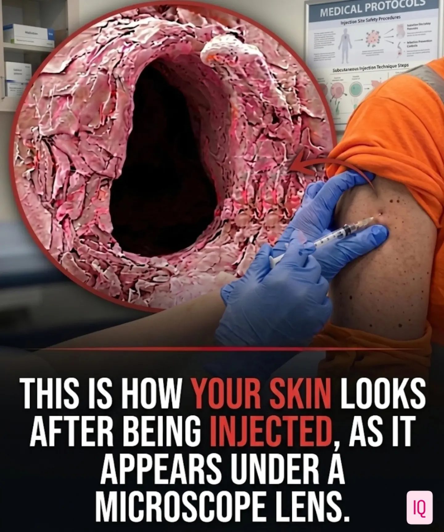 Understanding Skin Tissue: Microscopic View of Injections
