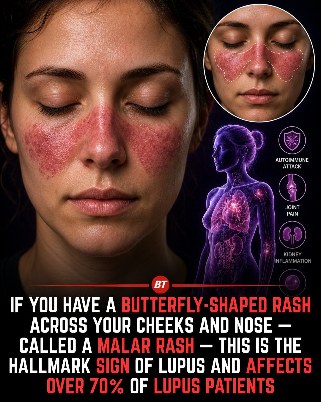 Recognize Lupus: Butterfly Rash and What It Means