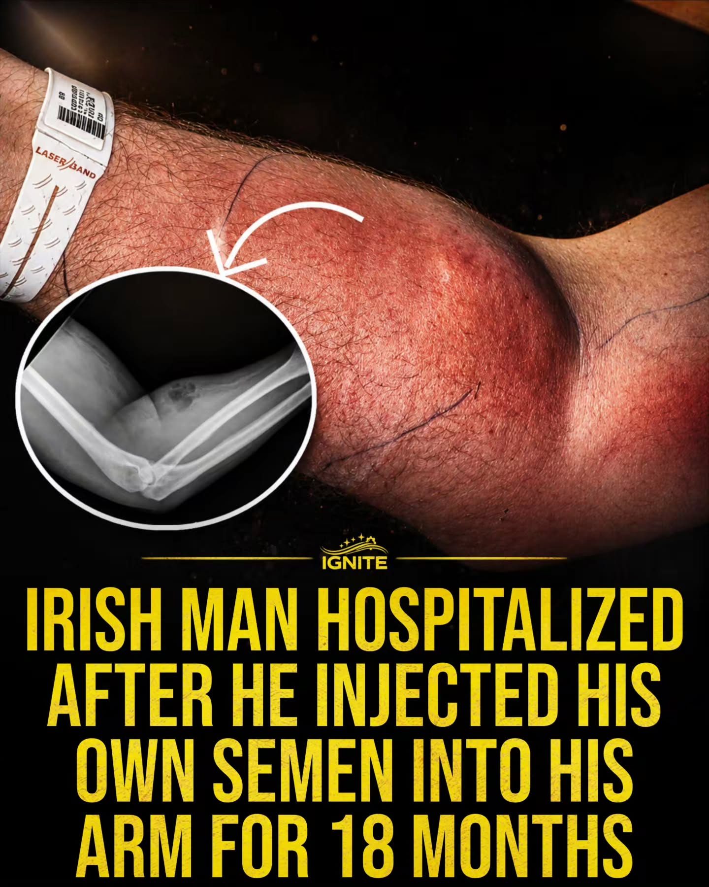 Irish Man Hospitalized After 18-Month Semen Injection