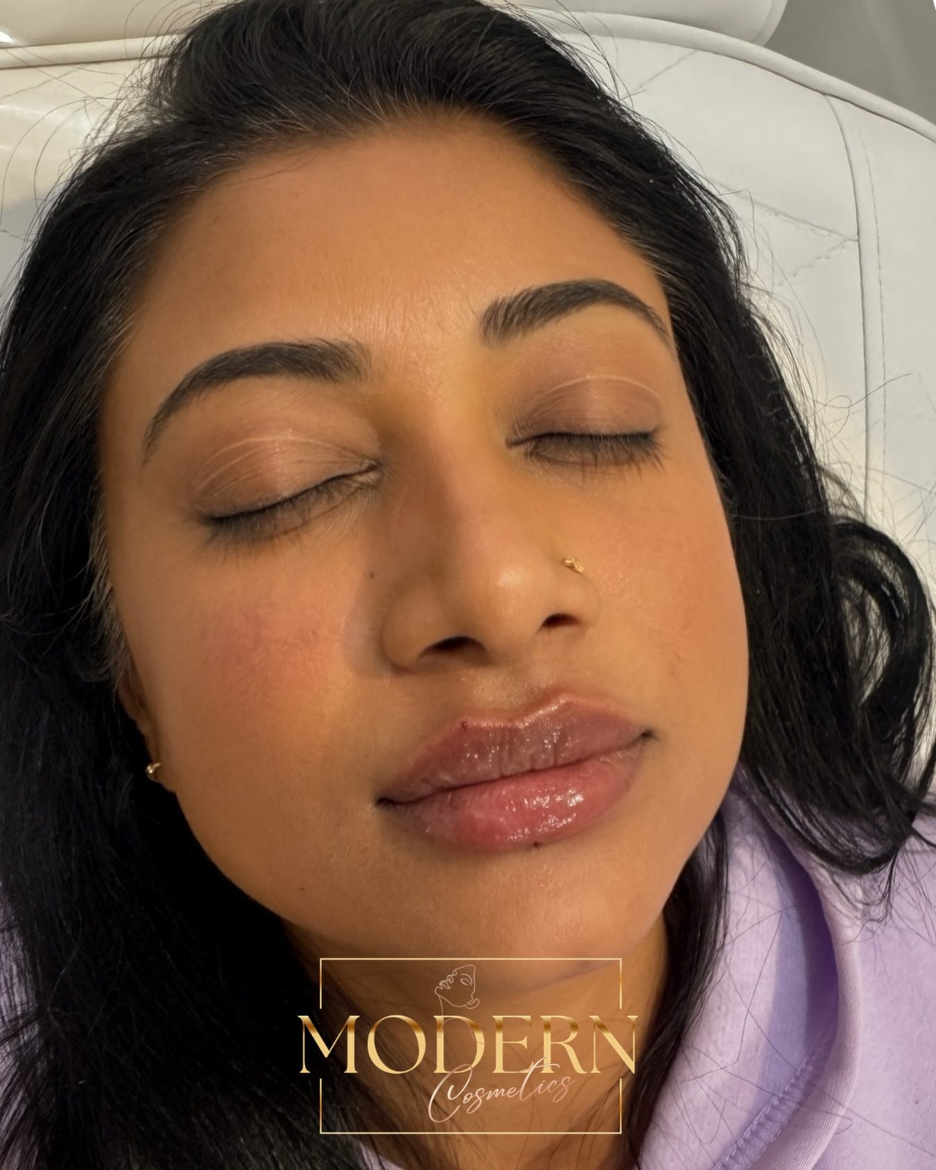 Discover Personalised Lip Filler Results at Modern Cosmetics