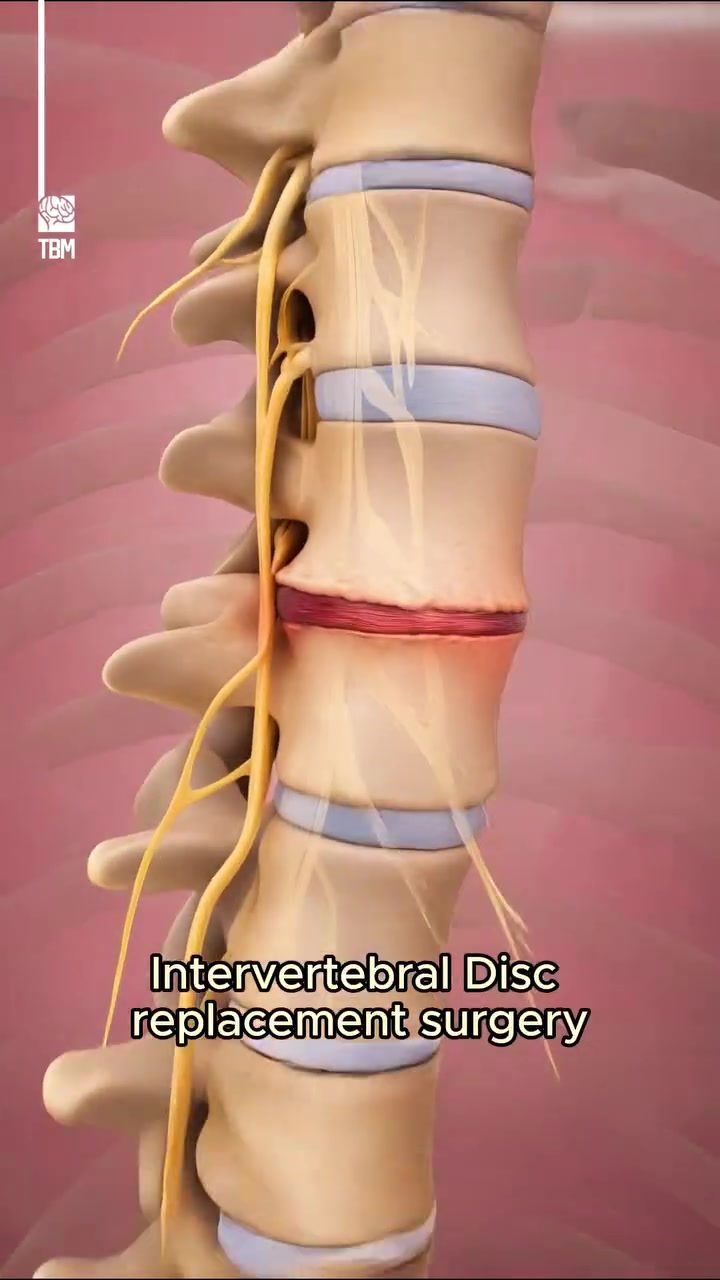 Intervertebral Disc Replacement: Relief and Mobility Restored