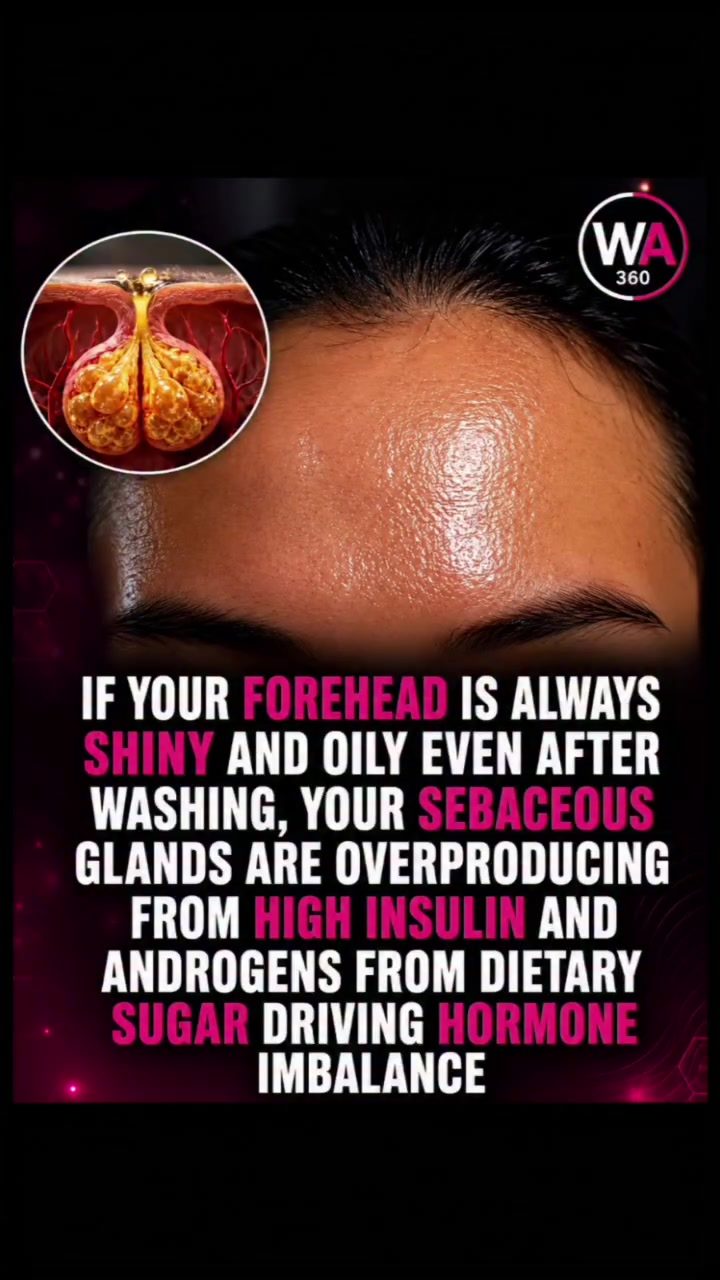 Oily Forehead: A Sign of Hormonal Imbalance