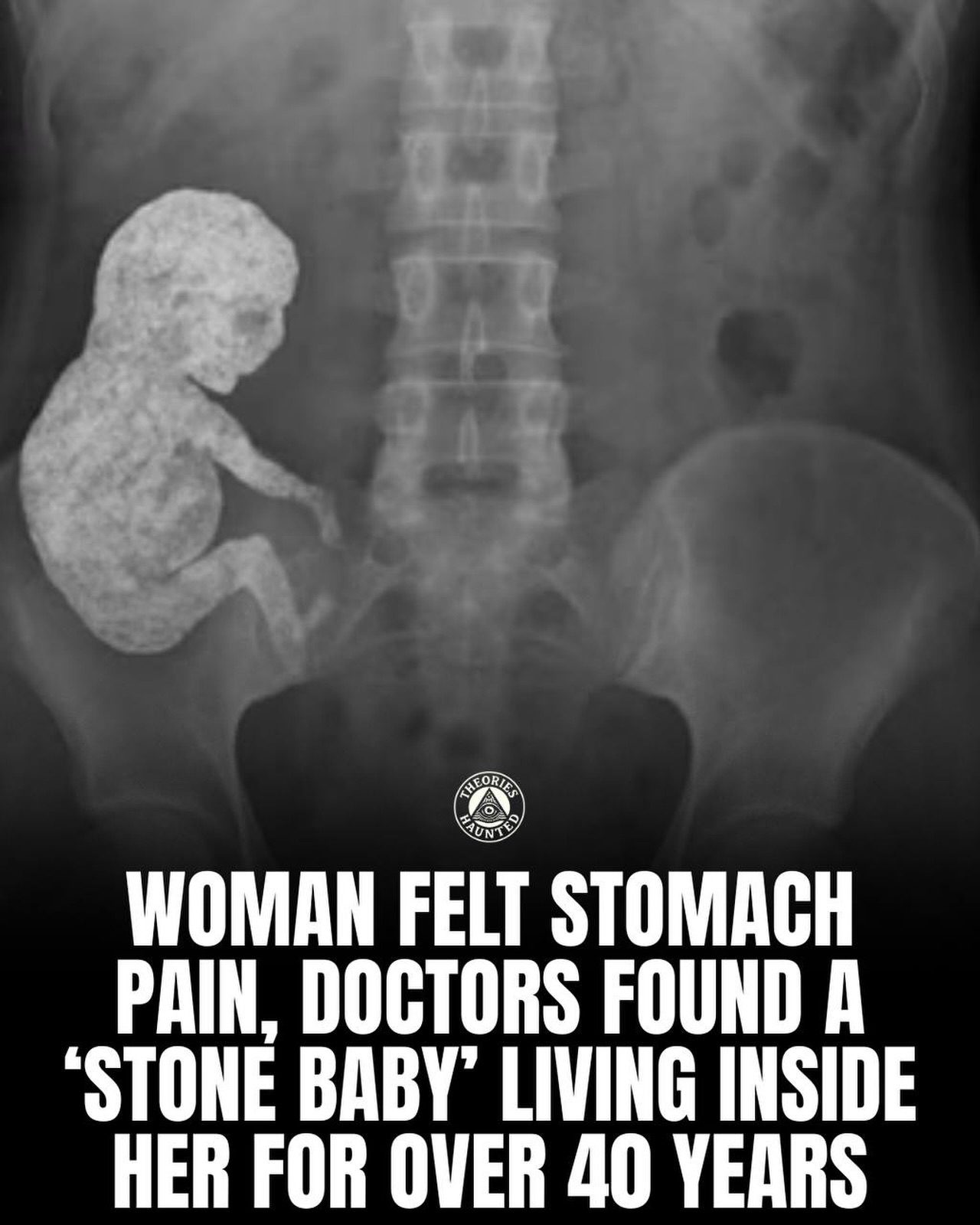 Rare Medical Mystery: The Stone Baby Phenomenon