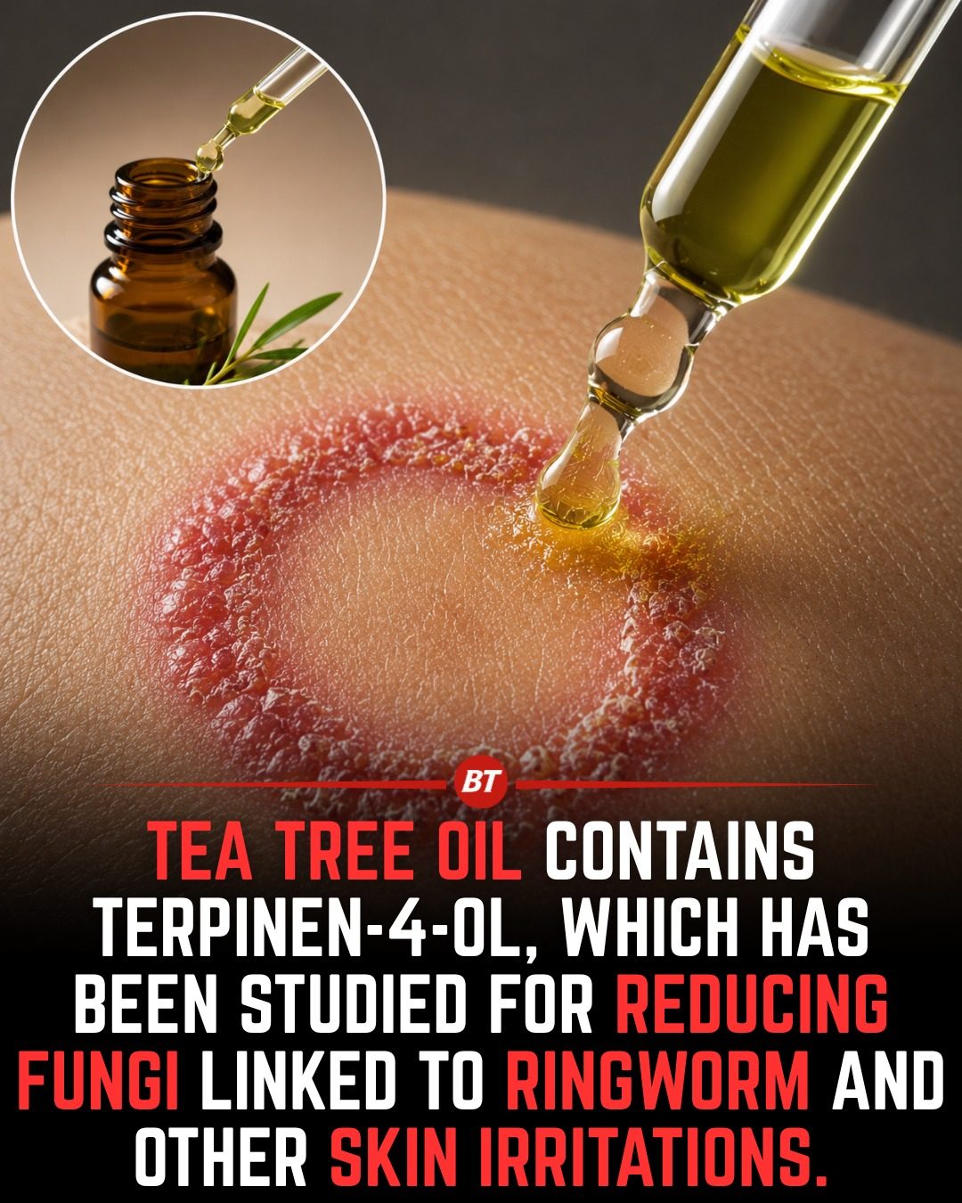 Tea Tree Oil: Effective Natural Treatment for Ringworm