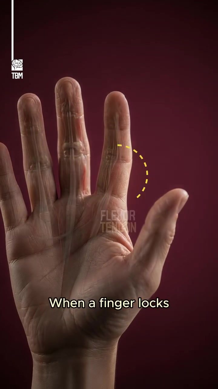 Trigger Finger: Causes and Mechanism Explained