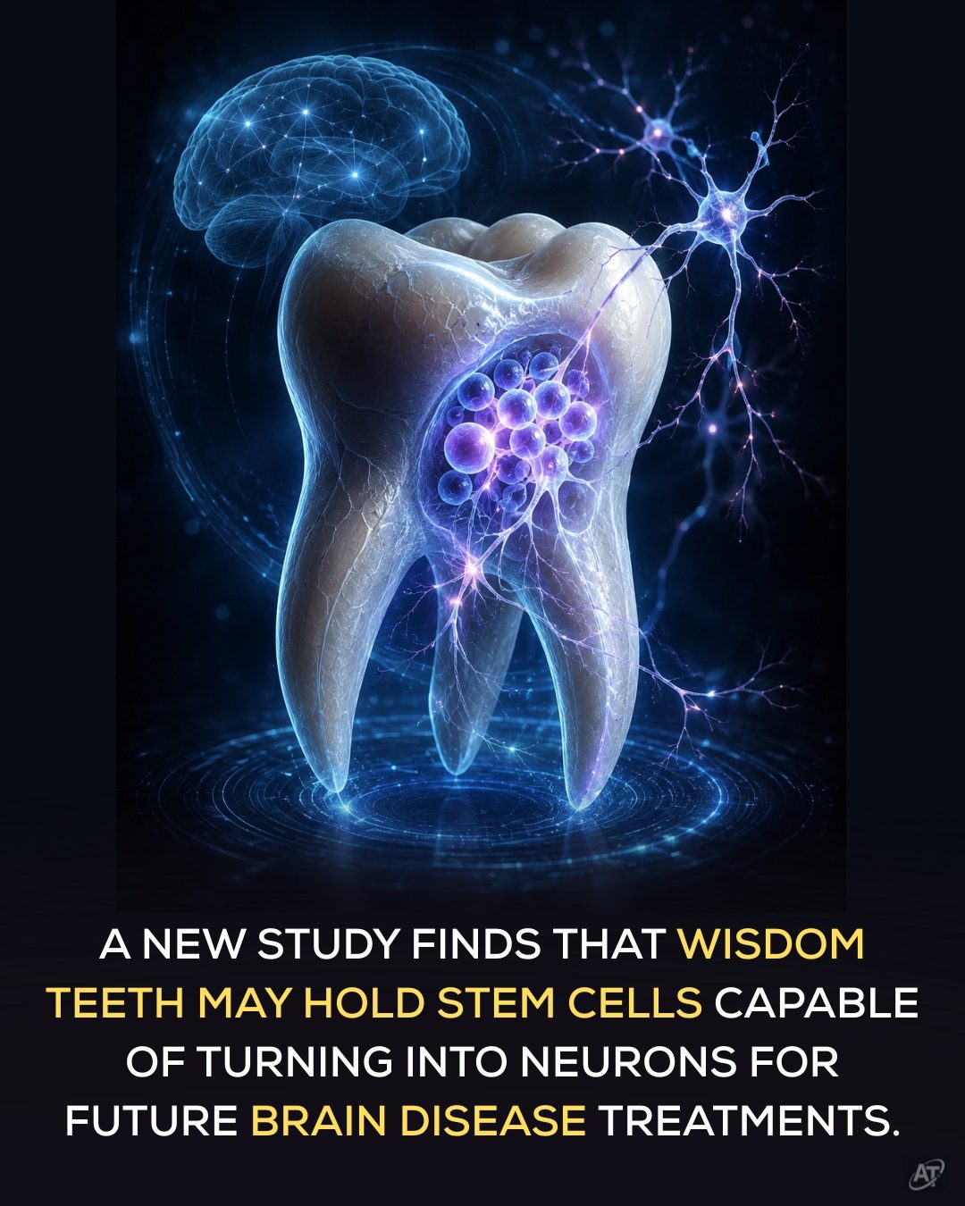 Wisdom Teeth: A Hidden Source of Stem Cells for Brain Research
