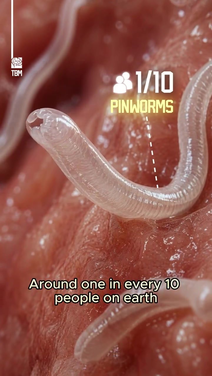 Pinworm Infection: Causes, Symptoms, and Prevention