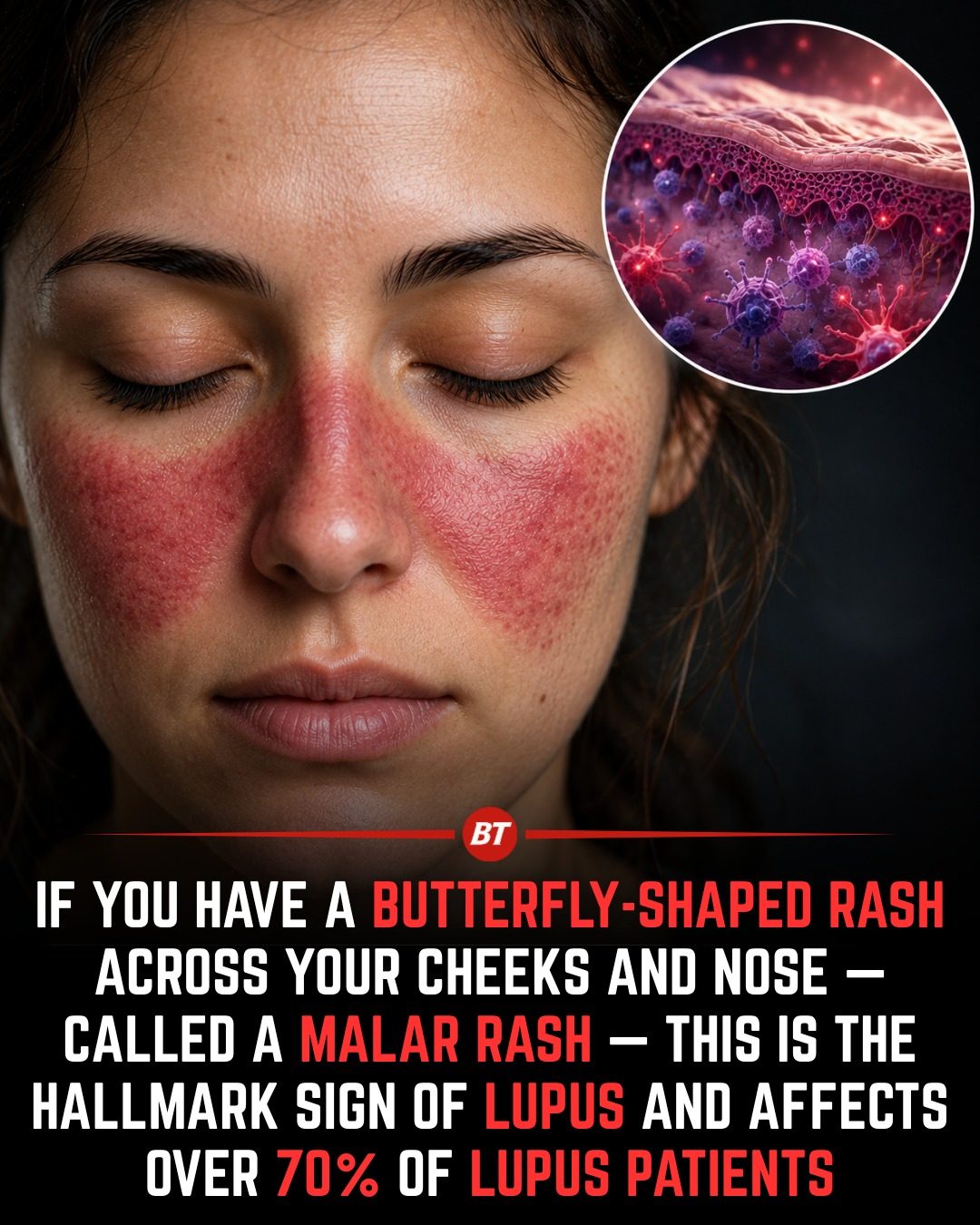 Recognizing Lupus: The Butterfly Rash and Malar Rash